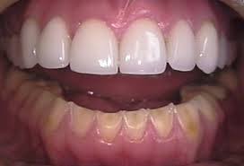 Dental veneers 14